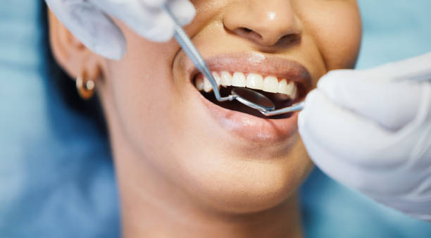 Best Emergency Dentist for Lost Fillings or Crowns in Lakeland North, WA
